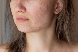 Dermatolożka ostrzega przed urodowym trendem. Mówi o skutkach ubocznych