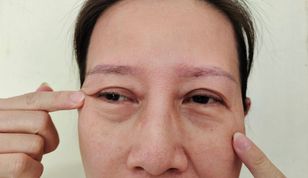 Tak wygląda „kortyzolowa twarz”. Endokrynolożka ostrzega