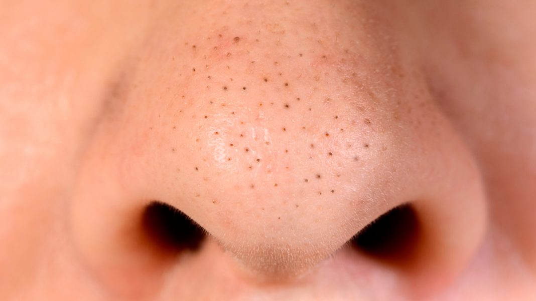 Domowa maska na wągry. Działa jak odkurzacz