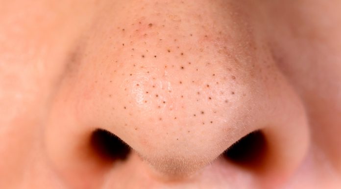 Domowa maska na wągry. Działa jak odkurzacz