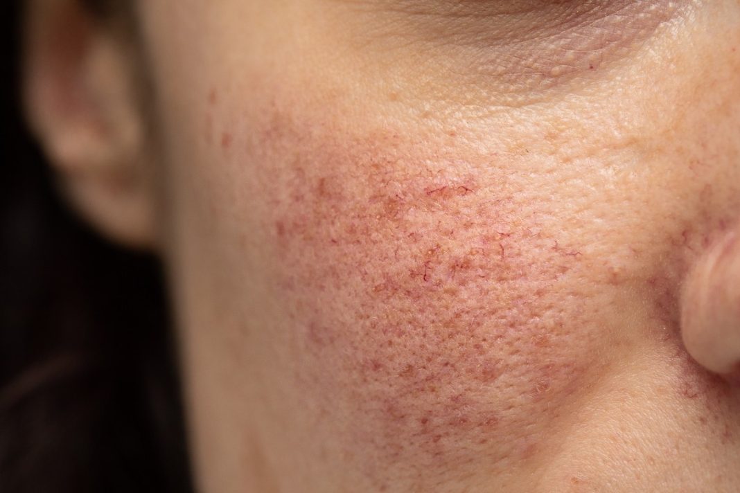 Pękające od zimna i wiatru naczynka — jak chronić twarz jesienią?