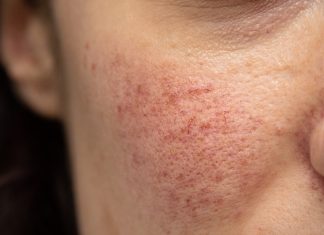 Pękające od zimna i wiatru naczynka — jak chronić twarz jesienią?