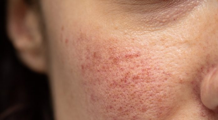 Pękające od zimna i wiatru naczynka — jak chronić twarz jesienią?