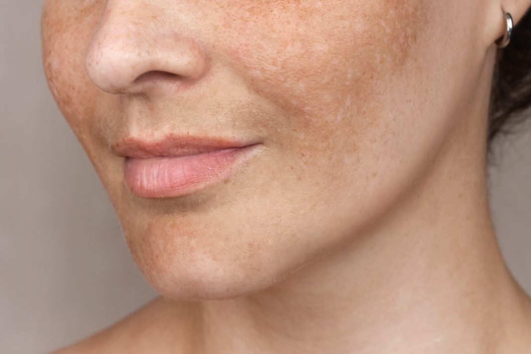 Zaawansowana redukcja przebarwień w domu. Trzy sera, które działają jak wymazujący laser