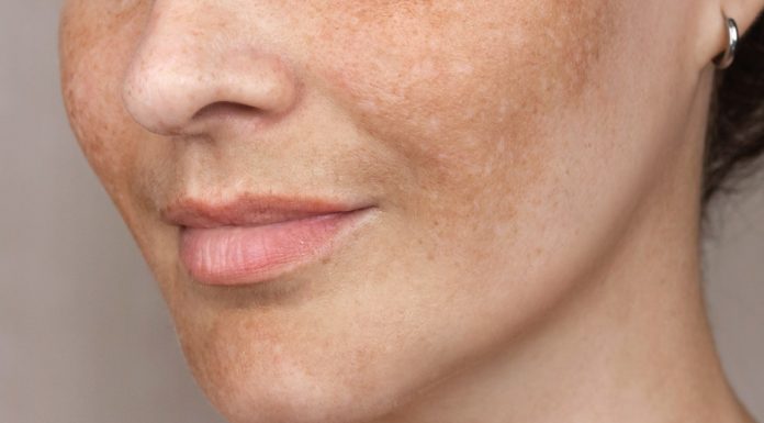 Zaawansowana redukcja przebarwień w domu. Trzy sera, które działają jak wymazujący laser