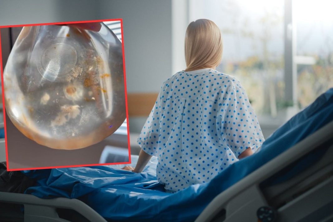 Usuwają implanty, wracają do naturalnych piersi.