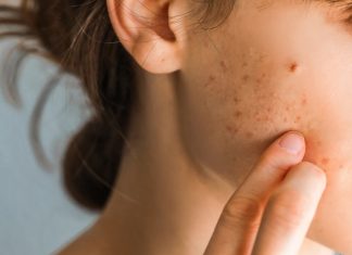 Produkt z kuchni zmniejszy blizny i zwalczy niedoskonałości. Wystarczy kilkanaście złotych