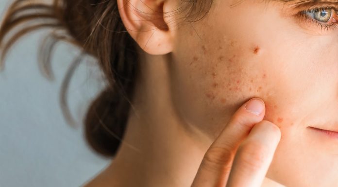 Produkt z kuchni zmniejszy blizny i zwalczy niedoskonałości. Wystarczy kilkanaście złotych