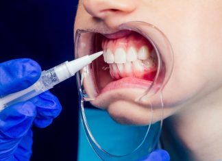 Ile kosztują „tureckie zęby”? W cenie jest przelot i nocleg w hotelu