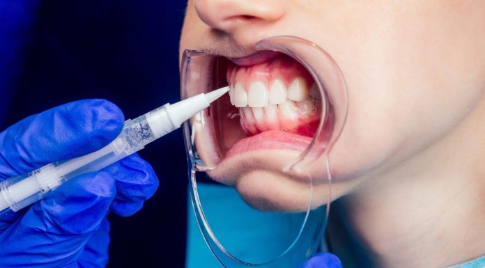 Ile kosztują „tureckie zęby”? W cenie jest przelot i nocleg w hotelu