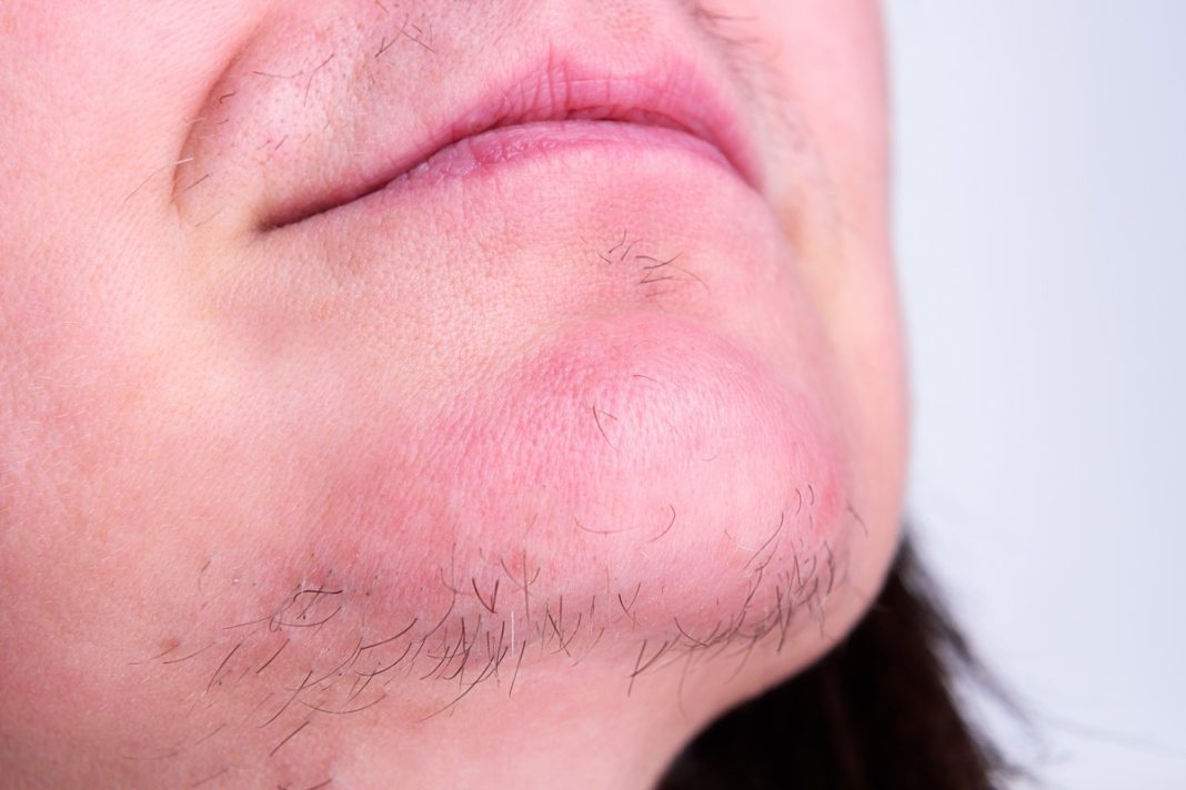 Włosy na brodzie to częsta przypadłość. Tak się ich pozbędziesz raz na zawsze