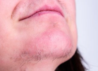 Włosy na brodzie to częsta przypadłość. Tak się ich pozbędziesz raz na zawsze