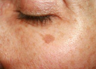 Ten peeling wymazuje przebarwienia z twarzy jak gumka! Działa już w 15 dni