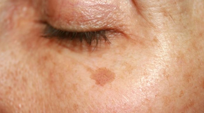 Ten peeling wymazuje przebarwienia z twarzy jak gumka! Działa już w 15 dni