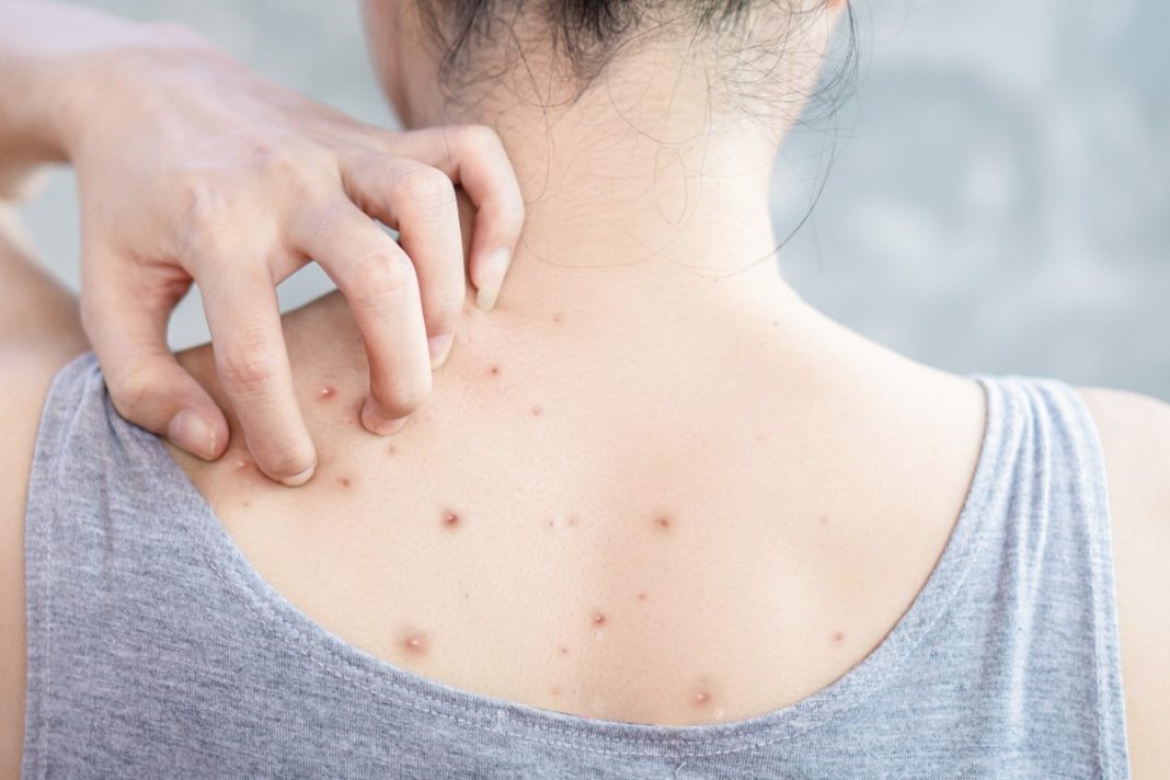 Niedoskonałości na plecach? Ten preparat pomoże ci się ich pozbyć