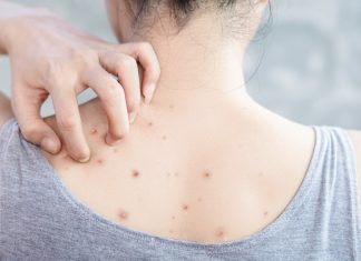 Niedoskonałości na plecach? Ten preparat pomoże ci się ich pozbyć