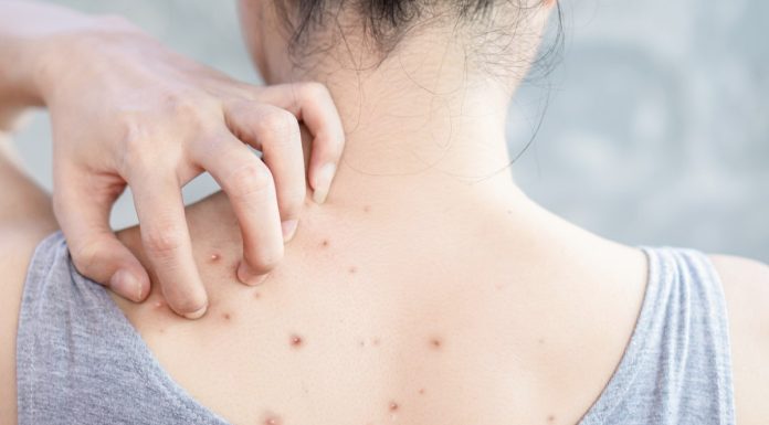 Niedoskonałości na plecach? Ten preparat pomoże ci się ich pozbyć