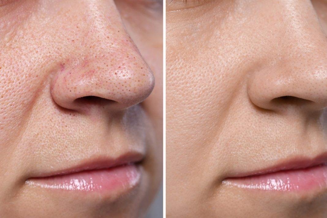 TOP 3 peelingi enzymatyczne. Wymiatają zaskórniki, nie podrażniają skóry