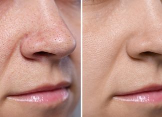 TOP 3 peelingi enzymatyczne. Wymiatają zaskórniki, nie podrażniają skóry