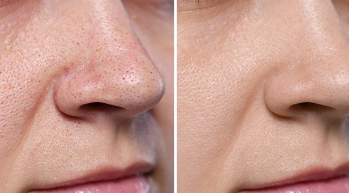 TOP 3 peelingi enzymatyczne. Wymiatają zaskórniki, nie podrażniają skóry