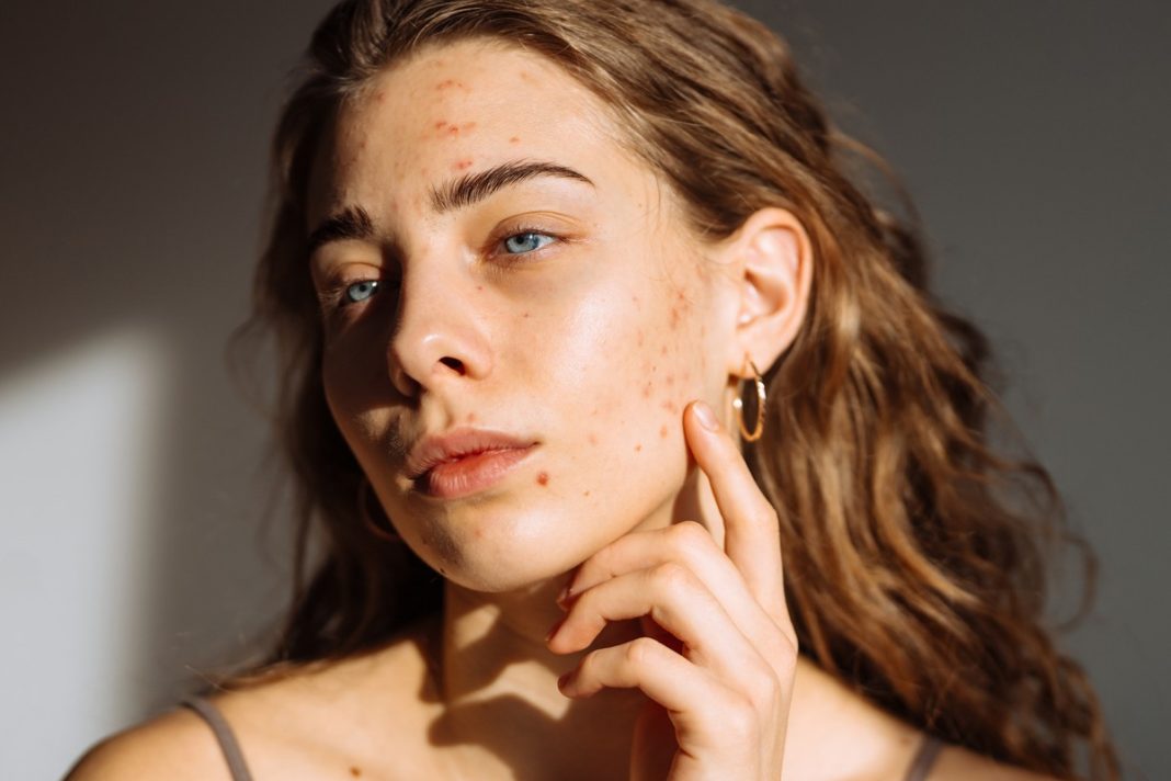 Trądzik nie odpuszcza, choć dawno już nie masz nastu lat? Ten koncentrat radzi sobie z nawracającymi niedoskonałościami w każdym wieku