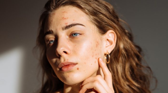 Trądzik nie odpuszcza, choć dawno już nie masz nastu lat? Ten koncentrat radzi sobie z nawracającymi niedoskonałościami w każdym wieku