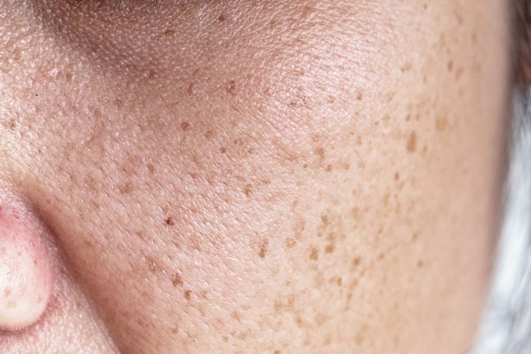 Najlepsze kosmetyki na przebarwienia — redukują plamy na twarzy