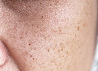 Najlepsze kosmetyki na przebarwienia — redukują plamy na twarzy