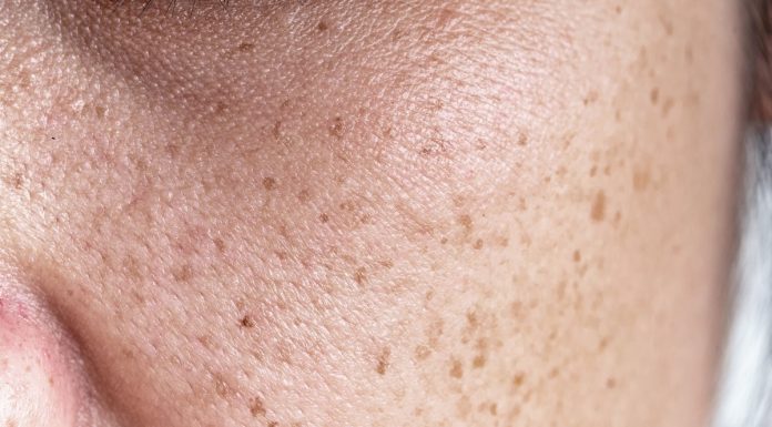 Najlepsze kosmetyki na przebarwienia — redukują plamy na twarzy