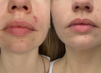 Serum, które „wycofuje” krostki spod skóry. Efekt widoczny już po tygodniu stosowania!