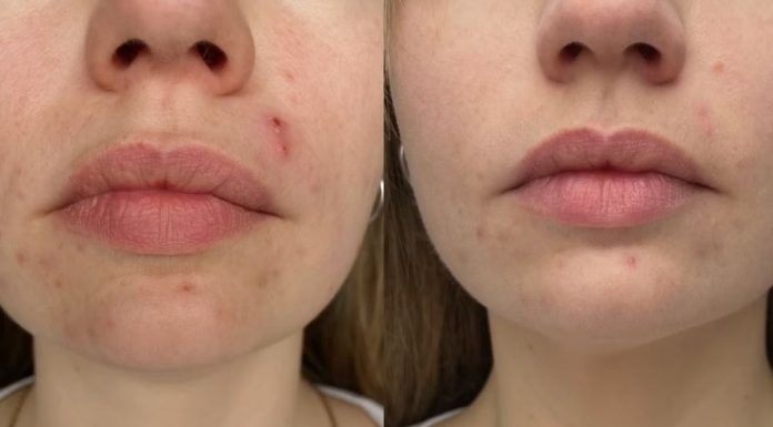 Serum, które „wycofuje” krostki spod skóry. Efekt widoczny już po tygodniu stosowania!