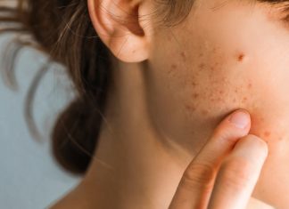 Serum z cynkiem zwęża pory i zwalcza niedoskonałości. Hit do cery tłustej i trądzikowej!