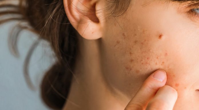 Serum z cynkiem zwęża pory i zwalcza niedoskonałości. Hit do cery tłustej i trądzikowej!