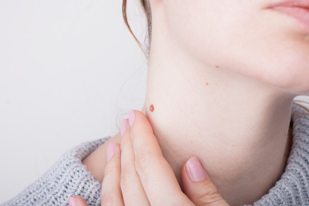 Trzy preparaty, które skutecznie usuną kurzajki