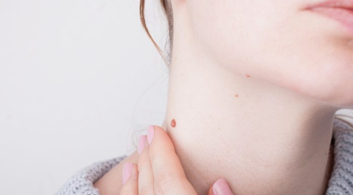 Trzy preparaty, które skutecznie usuną kurzajki