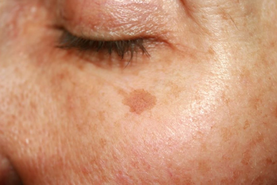 Top cztery peelingi rozjaśniające. To pogromcy przebarwień!