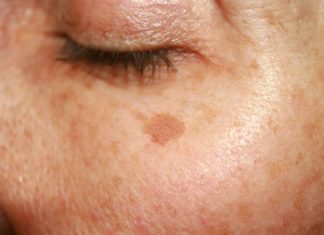 Top cztery peelingi rozjaśniające. To pogromcy przebarwień!