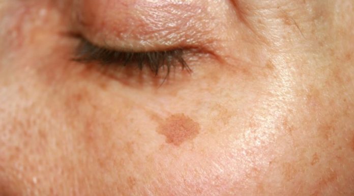 Top cztery peelingi rozjaśniające. To pogromcy przebarwień!