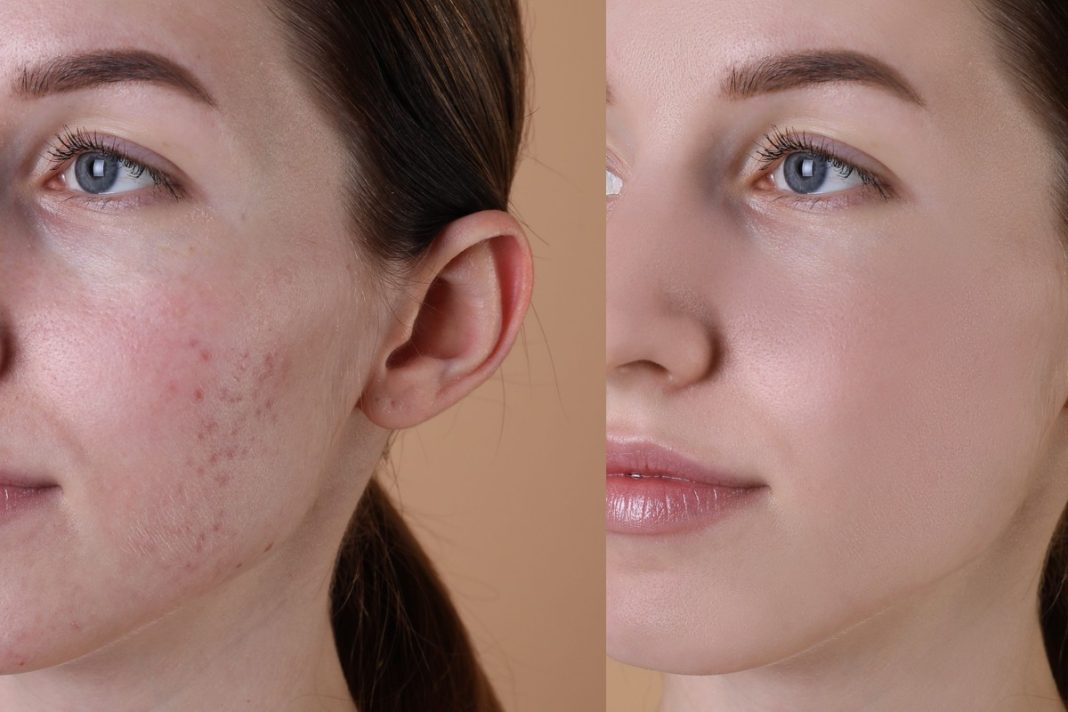 Mineralny krem z witaminą A to zbawca problematycznej skóry.