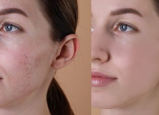 Mineralny krem z witaminą A to zbawca problematycznej skóry. „Używam od lat”