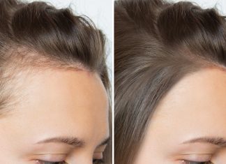 TOP 3 wcierki na mocno przerzedzone włosy. „Jestem w szoku, pożegnałam zakola”