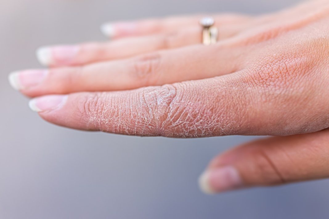 TOP kremy na szorstkie dłonie. Najlepszy kosztuje 16 zł i działa jak kojący opatrunek