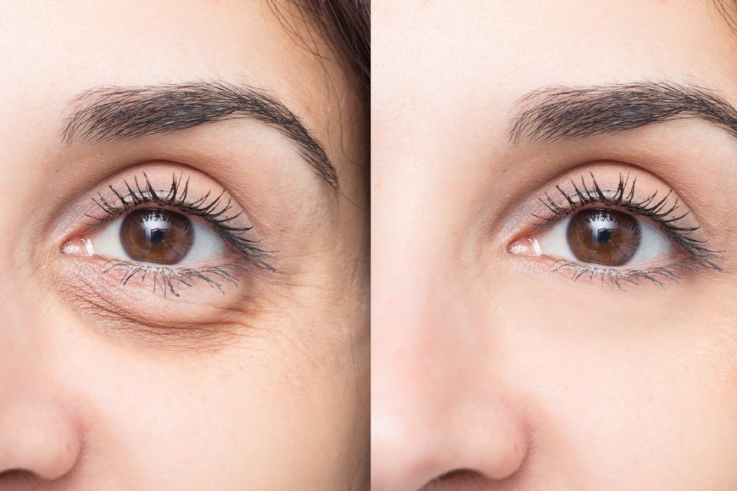 Kremy z kofeiną, dzięki którym pozbędziesz się worków pod oczami