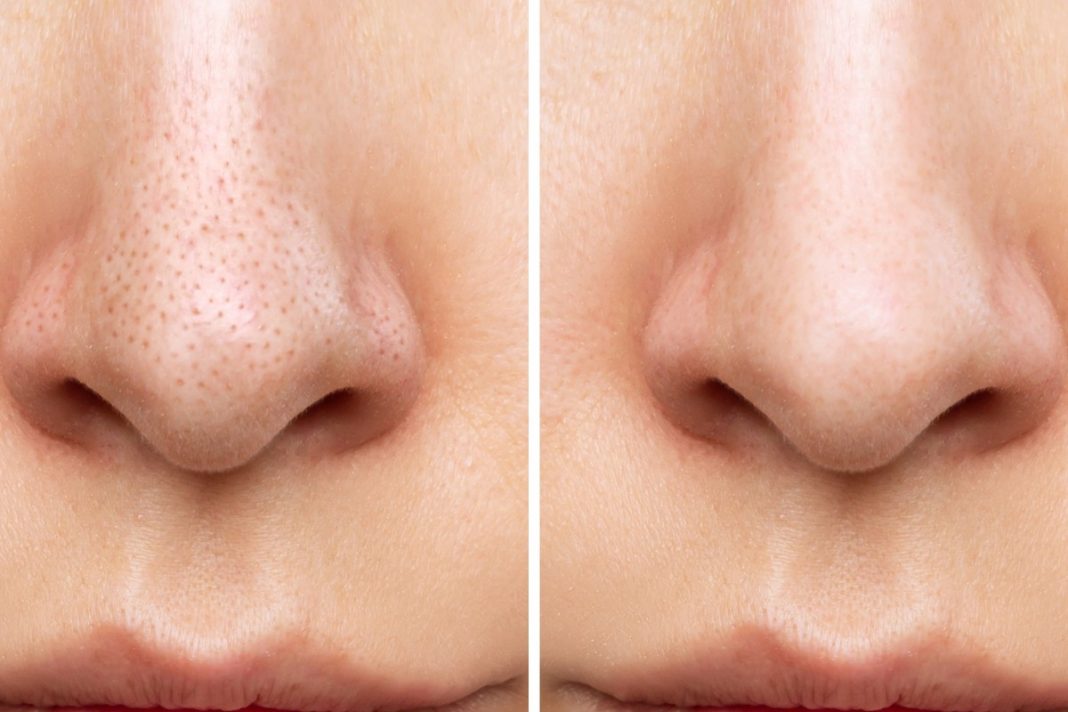 Pięć kosmetyków, które wymiotą czarne wągry z twojego nosa. Zapomnij o zaskórnikach!