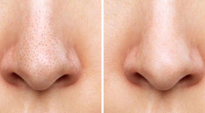 Pięć kosmetyków, które wymiotą czarne wągry z twojego nosa. Zapomnij o zaskórnikach!