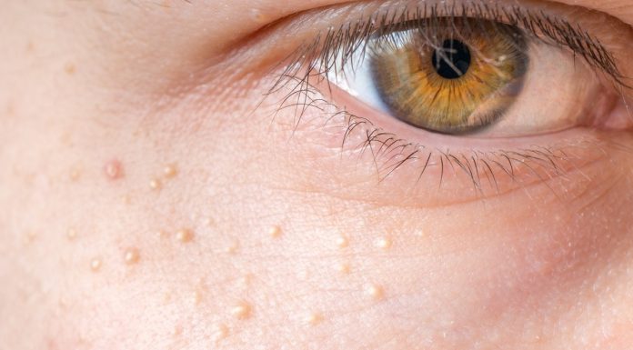 Pięć kosmetyków, które pomogą w pozbyciu się prosaków. Zapomnij o białych grudkach pod oczami