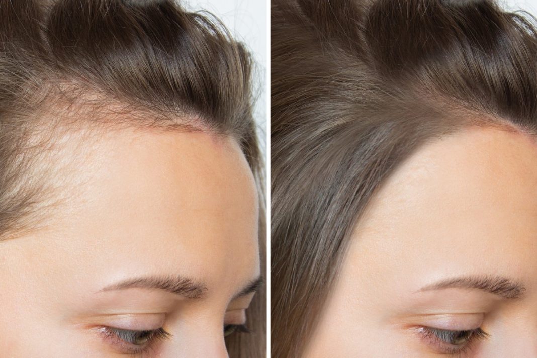 Najlepsza rozgrzewająca wcierka na przerzedzenia i zakola to ta.