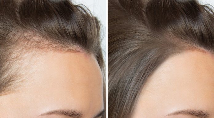 Najlepsza rozgrzewająca wcierka na przerzedzenia i zakola to ta. „Znowu pokochałam kucyk”