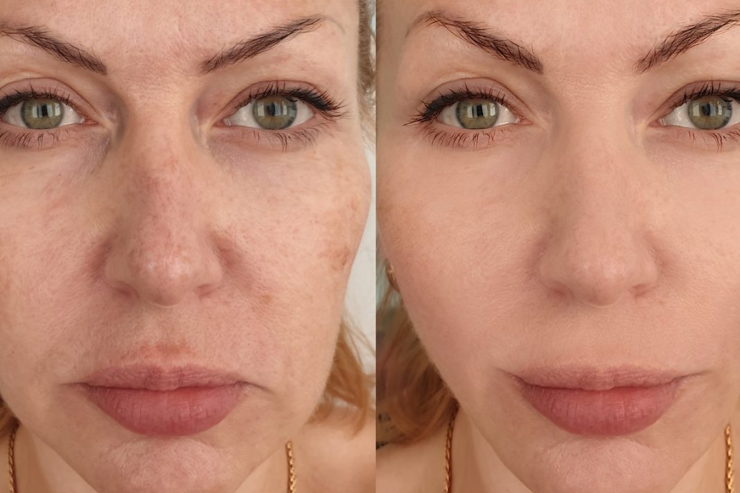 TOP 3 kremy na mocno widoczne przebarwienia. Spektakularne efekty już w 15 dni