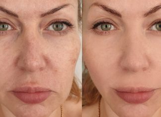 TOP 3 kremy na mocno widoczne przebarwienia. Spektakularne efekty już w 15 dni